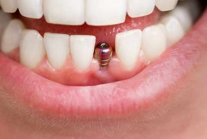 Implantes dentales