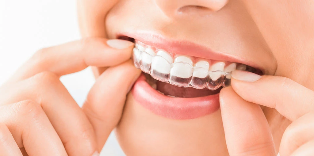 Ortodoncia e Invisalign